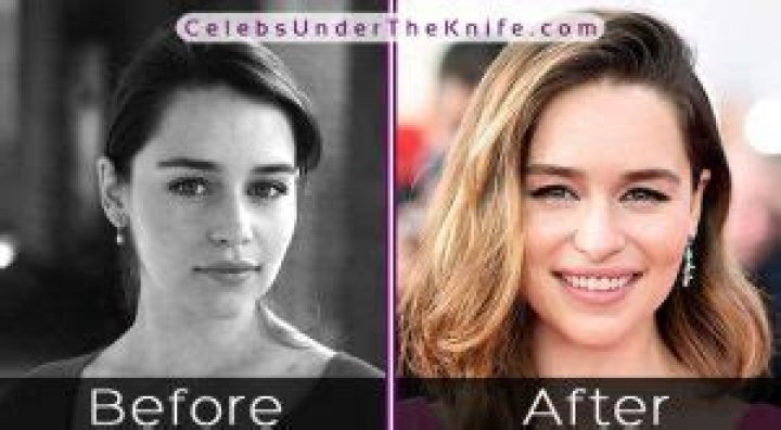 Emilia Clarke Plastic Surgery Before and After